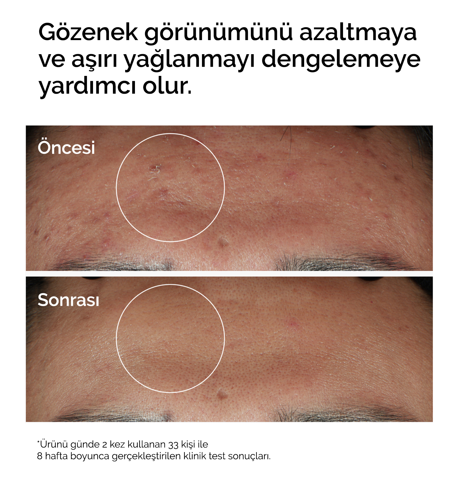 The Ordinary gözenek görünümünü azaltmaya yardımcı formül