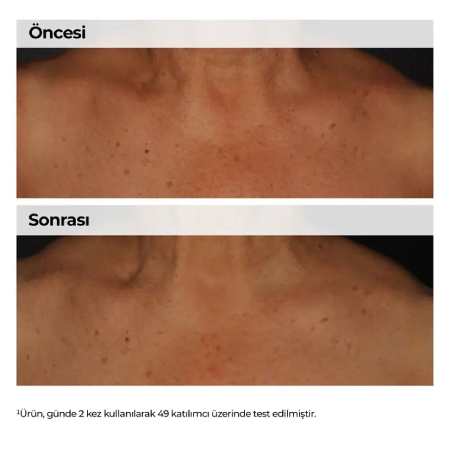 Vücut bölgesinde niacinamide kullanım sonucu