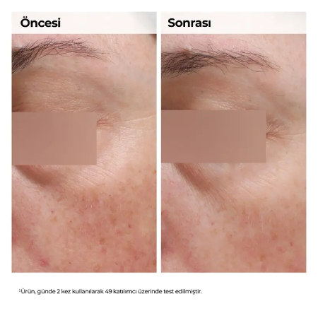 Yüz bölgesinde niacinamide kullanım öncesi sonrası